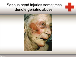 Serious head injuries sometimes 
denote geriatric abuse. 
 