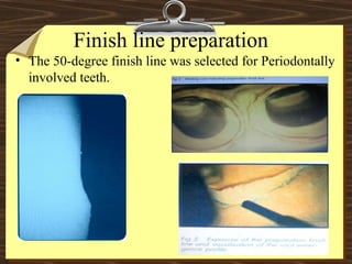 Finish line preparation
• The 50-degree finish line was selected for Periodontally
involved teeth.
 