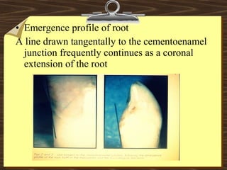 • Emergence profile of root
A line drawn tangentally to the cementoenamel
junction frequently continues as a coronal
extension of the root
 