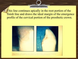 • This line continues apically in the root portion of the
finish line and draws the ideal margin of the emergence
profile of the cervical portion of the prosthetic crown.
 