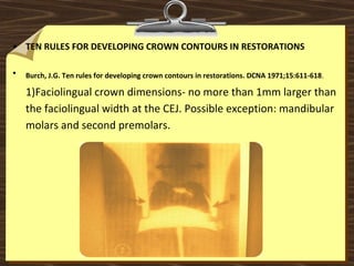 • TEN RULES FOR DEVELOPING CROWN CONTOURS IN RESTORATIONS
• Burch, J.G. Ten rules for developing crown contours in restorations. DCNA 1971;15:611-618.  
1)Faciolingual crown dimensions- no more than 1mm larger than 
the faciolingual width at the CEJ. Possible exception: mandibular 
molars and second premolars.
 
 