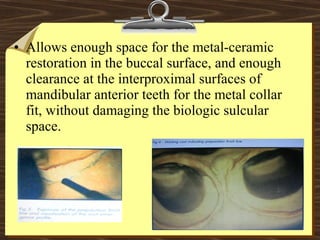 • Allows enough space for the metal-ceramic
restoration in the buccal surface, and enough
clearance at the interproximal surfaces of
mandibular anterior teeth for the metal collar
fit, without damaging the biologic sulcular
space.
 