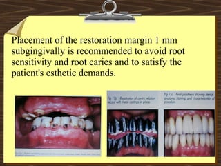 Placement of the restoration margin 1 mm
subgingivally is recommended to avoid root
sensitivity and root caries and to satisfy the
patient's esthetic demands.
 