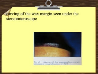 carving of the wax margin seen under the
stereomicroscope
 