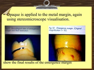 • Opaque is applied to the metal margin, again
using stereomicroscope visualisation.
show the final results of the emergence margin
 