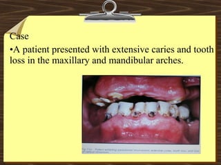 Case
•A patient presented with extensive caries and tooth
loss in the maxillary and mandibular arches.
 