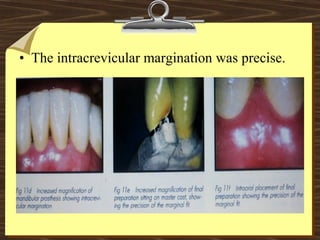 • The intracrevicular margination was precise.
 