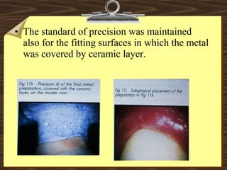 • The standard of precision was maintained
also for the fitting surfaces in which the metal
was covered by ceramic layer.
 