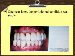 • One year later, the periodontal condition was
stable.
 