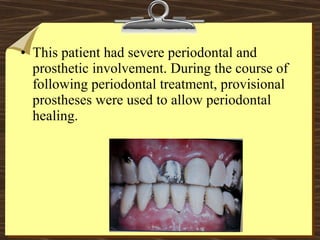 • This patient had severe periodontal and
prosthetic involvement. During the course of
following periodontal treatment, provisional
prostheses were used to allow periodontal
healing.
 