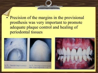 • Precision of the margins in the provisional
prosthesis was very important to promote
adequate plaque control and healing of
periodontal tissues
 