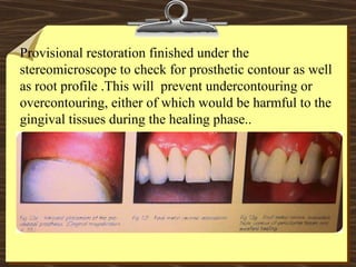 Provisional restoration finished under the
stereomicroscope to check for prosthetic contour as well
as root profile .This will prevent undercontouring or
overcontouring, either of which would be harmful to the
gingival tissues during the healing phase..
 