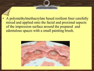 • A polymethylmethacrylate based resilient liner carefully
mixed and applied onto the facial and proximal aspects
of the impression surface around the prepared and
edentulous spaces with a small painting brush.
 