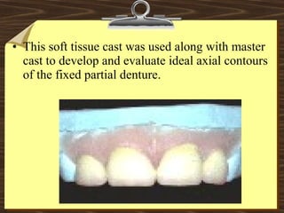 • This soft tissue cast was used along with master
cast to develop and evaluate ideal axial contours
of the fixed partial denture.
 
