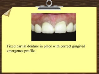 Fixed partial denture in place with correct gingival
emergence profile.
 