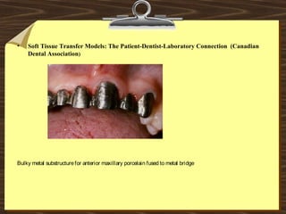 • Soft Tissue Transfer Models: The Patient-Dentist-Laboratory Connection (Canadian
Dental Association)
Bulky metal substructurefor anterior maxillary porcelain fused to metal bridge
 