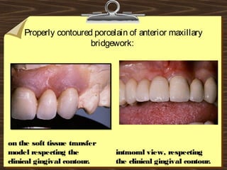 Properly contoured porcelain of anterior maxillary
bridgework:
on the soft tissue transfer
model respecting the
clinical gingival contour.
intraoral view, respecting
the clinical gingival contour.
 