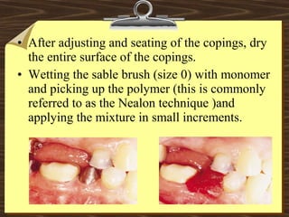 • After adjusting and seating of the copings, dry
the entire surface of the copings.
• Wetting the sable brush (size 0) with monomer
and picking up the polymer (this is commonly
referred to as the Nealon technique )and
applying the mixture in small increments.
 
