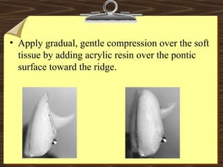 • Apply gradual, gentle compression over the soft
tissue by adding acrylic resin over the pontic
surface toward the ridge.
 