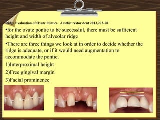 Ridge Evaluation of Ovate Pontics J esthet restor dent 2013,273-78
•for the ovate pontic to be successful, there must be sufficient
height and width of alveolar ridge
•There are three things we look at in order to decide whether the
ridge is adequate, or if it would need augmentation to
accommodate the pontic.
1)Interproximal height
2)Free gingival margin
3)Facial prominence
 
