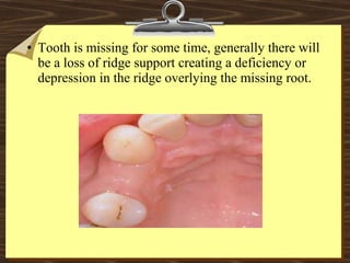 • Tooth is missing for some time, generally there will
be a loss of ridge support creating a deficiency or
depression in the ridge overlying the missing root.
 