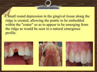 A small round depression in the gingival tissue along the
ridge is created, allowing the pontic to be embedded
within the "crater" so as to appear to be emerging from
the ridge as would be seen in a natural emergence
profile.
 
