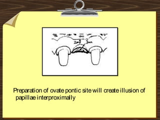 Preparation of ovatepontic sitewill createillusion of
papillaeinterproximally
 