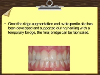• Oncetheridgeaugmentation and ovatepontic sitehas
been developed and supported during healing with a
temporary bridge, thefinal bridgecan befabricated.
 
