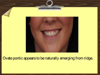 Ovatepontic appearsto benaturally emerging from ridge.
 