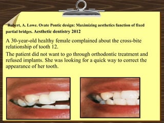 Robert, A. Lowe. Ovate Pontic design: Maximizing aesthetics function of fixed
partial bridges. Aesthetic dentistry 2012
A 30-year-old healthy female complained about the cross-bite
relationship of tooth 12.
The patient did not want to go through orthodontic treatment and
refused implants. She was looking for a quick way to correct the
appearance of her tooth.
 