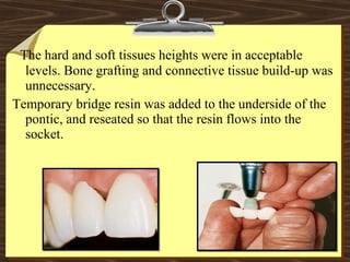 The hard and soft tissues heights were in acceptable
levels. Bone grafting and connective tissue build-up was
unnecessary.
Temporary bridge resin was added to the underside of the
pontic, and reseated so that the resin flows into the
socket.
 