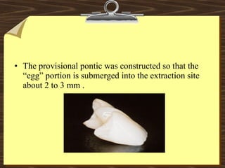 • The provisional pontic was constructed so that the
“egg” portion is submerged into the extraction site
about 2 to 3 mm .
 