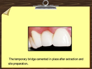 Thetemporary bridgecemented in placeafter extraction and
sitepreparation.
 