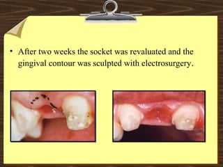 • After two weeks the socket was revaluated and the
gingival contour was sculpted with electrosurgery.
 