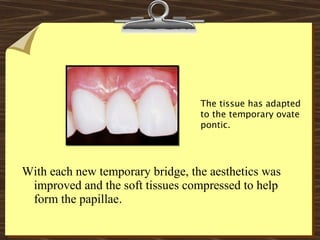 With each new temporary bridge, the aesthetics was
improved and the soft tissues compressed to help
form the papillae.
The tissue has adapted
to the temporary ovate
pontic.
 