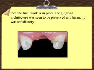Once the final work is in place, the gingival
architecture was seen to be preserved and harmony
was satisfactory
 