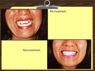 Pre-treatment.
Post-treatment.
 