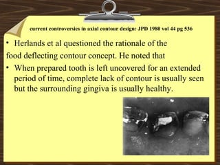 • Herlands et al questioned the rationale of the
food deflecting contour concept. He noted that
• When prepared tooth is left uncovered for an extended
period of time, complete lack of contour is usually seen
but the surrounding gingiva is usually healthy.
current controversies in axial contour design: JPD 1980 vol 44 pg 536
 