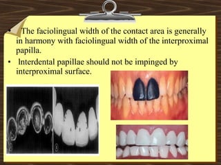 • The faciolingual width of the contact area is generally
in harmony with faciolingual width of the interproximal
papilla.
• lnterdental papillae should not be impinged by
interproximal surface.
 