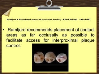 Ramfjord S. Periodontal aspects of restorative dentistry. J Oral Rehabil 1974;1:107
• Ramfjord recommends placement of contact
areas as far occlusally as possible to
facilitate access for interproximal plaque
control.
 