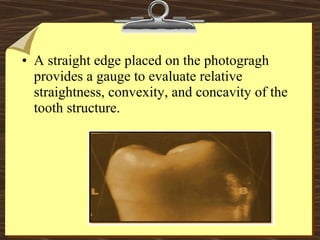• A straight edge placed on the photogragh
provides a gauge to evaluate relative
straightness, convexity, and concavity of the
tooth structure.
 