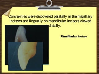 Convexitieswerediscovered palatally in themaxillary
incisorsand lingually on mandibular incisorsviewed
mesiodistally.
Maxillary incisor Mandibularincisor
 