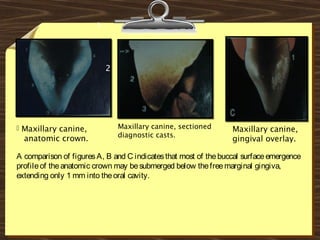  Maxillary canine,
anatomic crown.
Maxillary canine, sectioned
diagnostic casts.
Maxillary canine,
gingival overlay.
41
2
A comparison of figuresA, B and C indicatesthat most of thebuccal surfaceemergence
profileof theanatomic crown may besubmerged below thefreemarginal gingiva,
extending only 1 mm into theoral cavity.
 