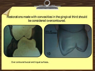 Restorationsmadewith convexitiesin thegingival third should
beconsidered overcontoured.
Over contoured buccal and lingual surfaces.
 