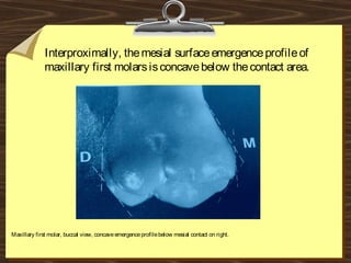 Interproximally, themesial surfaceemergenceprofileof
maxillary first molarsisconcavebelow thecontact area.
Maxillary first molar, buccal view, concaveemergenceprofilebelow mesial contact on right.
 
