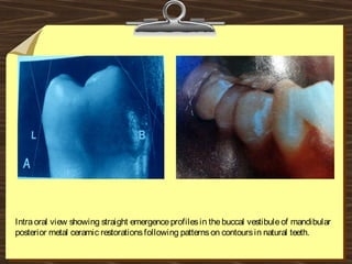 Intraoral view showing straight emergenceprofilesin thebuccal vestibuleof mandibular
posterior metal ceramic restorationsfollowing patternson contoursin natural teeth.
 