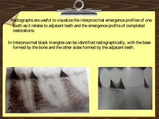 Radiographsareuseful to visualizetheinterproximal emergenceprofilesof one
tooth asit relatesto adjacent teeth and theemergenceprofileof completed
restorations.
In Interproximal black trianglescan beidentified radiographically, with thebase
formed by theboneand theother sidesformed by theadjacent teeth.
 