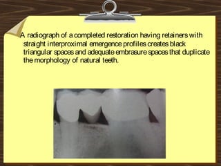 A radiograph of acompleted restoration having retainerswith
straight interproximal emergenceprofilescreatesblack
triangular spacesand adequateembrasurespacesthat duplicate
themorphology of natural teeth.
 