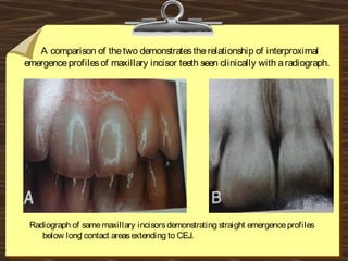 A comparison of thetwo demonstratestherelationship of interproximal
emergenceprofilesof maxillary incisor teeth seen clinically with aradiograph.
.
.
Radiograph of samemaxillary incisorsdemonstrating straight emergenceprofiles
below long contact areasextending to CEJ.
 