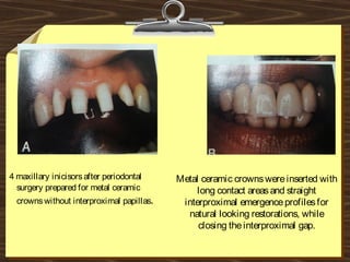 Metal ceramic crownswereinserted with
long contact areasand straight
interproximal emergenceprofilesfor
natural looking restorations, while
closing theinterproximal gap.
4 maxillary inicisorsafter periodontal
surgery prepared for metal ceramic
crownswithout interproximal papillas.
 